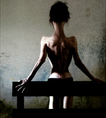 Fotos de anorexia