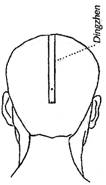 Acupuntura escalpeana